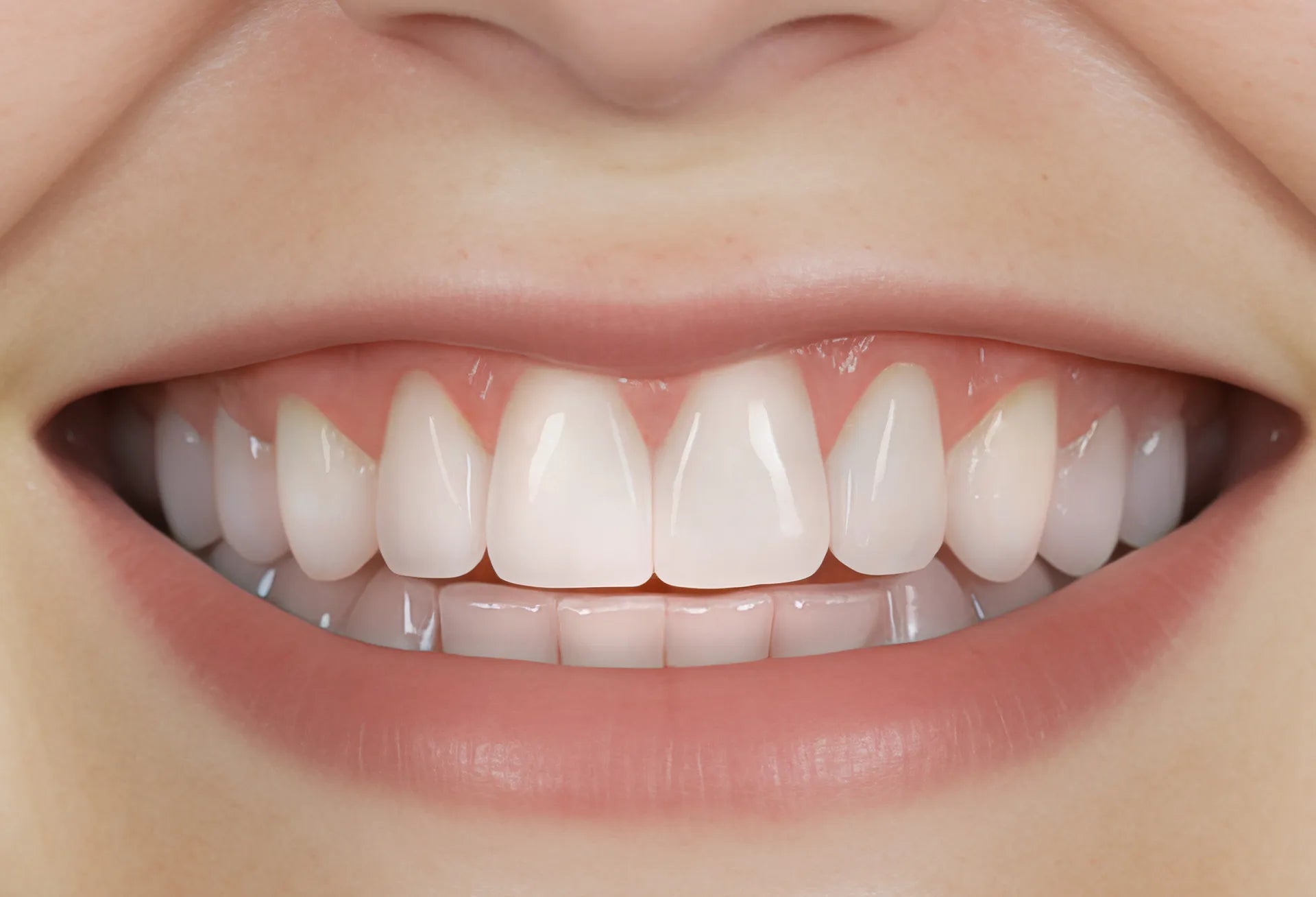 The before image showing plaque buildup and inflammed / irriated gums