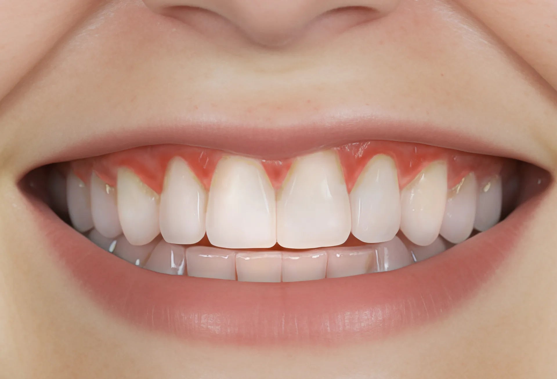 The before image showing plaque buildup and inflammed / irriated gums
